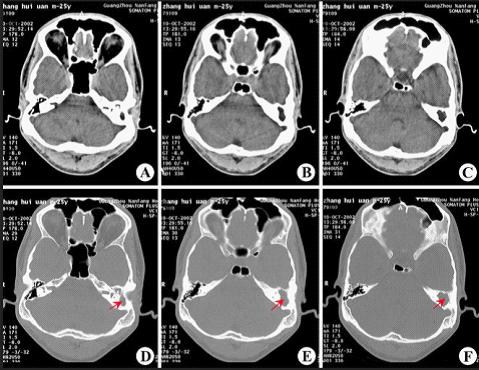 ct显示:左侧慢性中耳乳突炎(胆脂瘤型)
